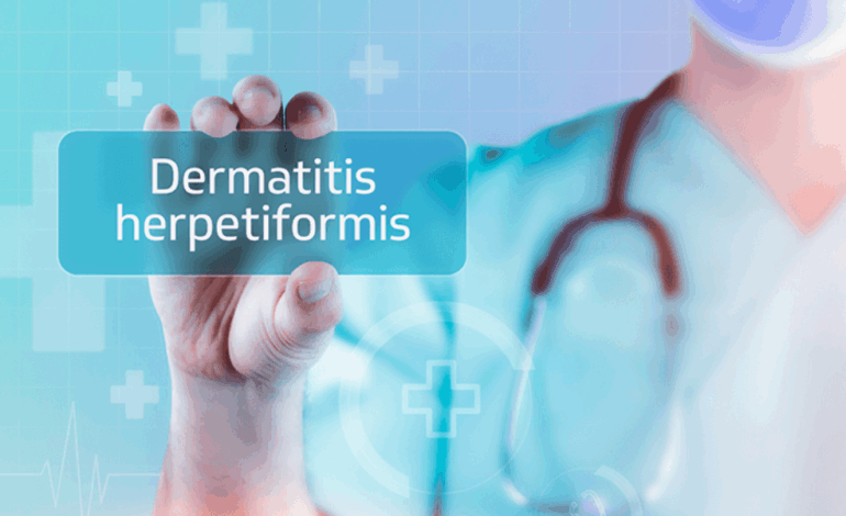 Dermatitis Herpetiformis: Causes, Symptoms, Diagnosis, and Treatment Overview