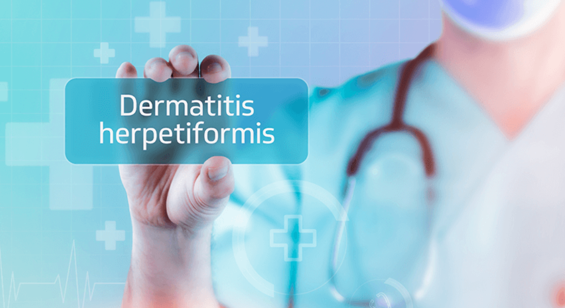 Dermatitis Herpetiformis: Causes, Symptoms, Diagnosis, and Treatment Overview