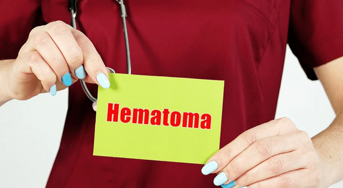 When Does a Hematoma Need to Be Drained?