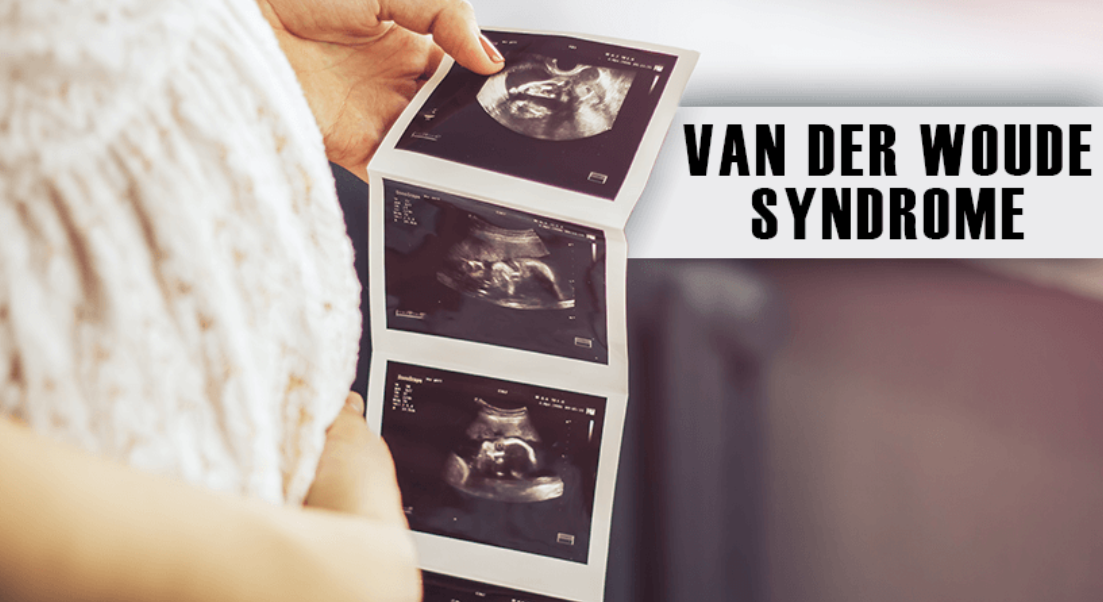 Understanding Van der Woude Syndrome (VWS): Genetics, Symptoms, Diagnosis, and Care