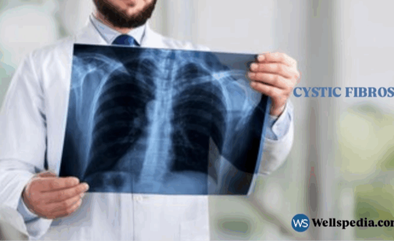 Alyftrek and Cystic Fibrosis: A New Era in Treatment