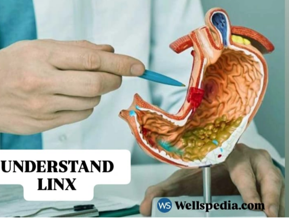 LINX Procedure for GERD: A Modern, Minimally Invasive Treatment Option