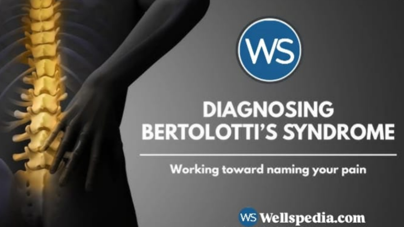 Bertolotti Syndrome: An Often Missed Cause of Chronic Lower Back Pain