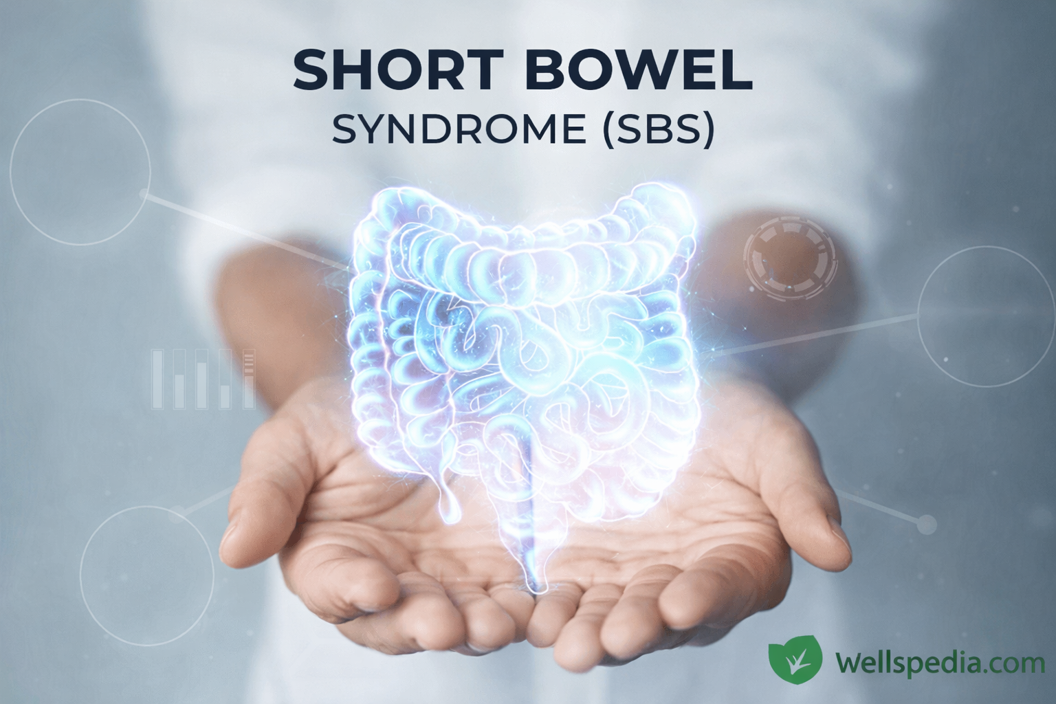 Understanding Short Bowel Syndrome (SBS): Causes, Symptoms & Treatment